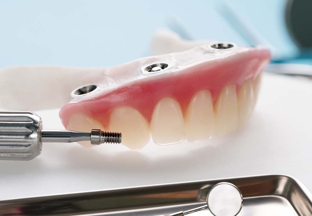 implant Denture